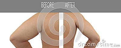 Arm men slimming before and after problem , collage oversize Stock Photo