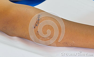 Arm stitched. Stock Photo