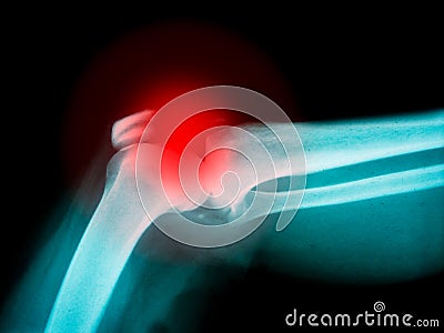 Arm X-ray with highlight on broken bone Stock Photo