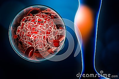 Arterial embolism or embolus located in the calf with blood clot or thrombus image 3D rendering illustration. Medicine, medical Cartoon Illustration