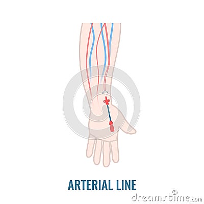 Arterial line catheter placed in the radial artery Vector Illustration