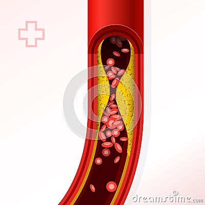 Artery with cholesterol buildup - cholesterol and thromb Vector Illustration