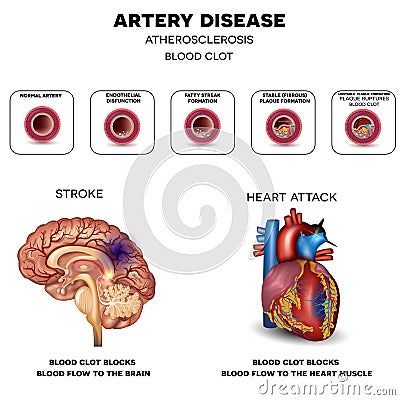 Artery disease, Atherosclerosis Vector Illustration