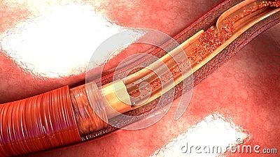 Artery Dissection Stock Photo