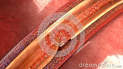 Artery Dissection Stock Photo