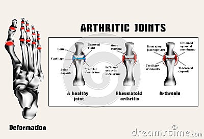 Arthritic joins Vector Illustration