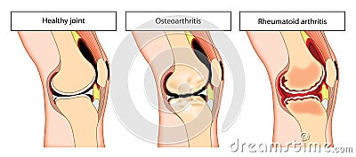 Arthritic knee joint Stock Photo