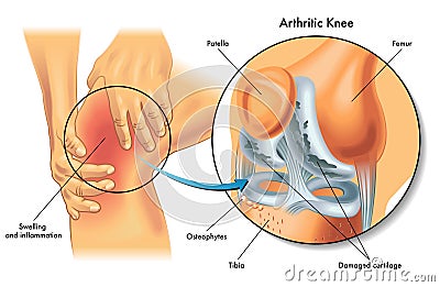 Arthritic knee Vector Illustration