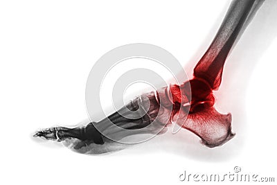 Arthritis of ankle . X-ray of foot . Lateral view . Invert color style . Gout or Rheumatoid concept Stock Photo