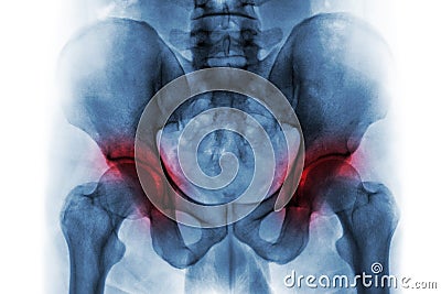 Arthritis both hip . Film x-ray of human pelvis . Stock Photo