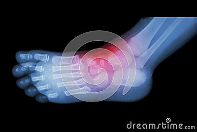 Arthritis and injury at ankle : film x-ray of child's foot ( side view ) ( lateral ) Stock Photo