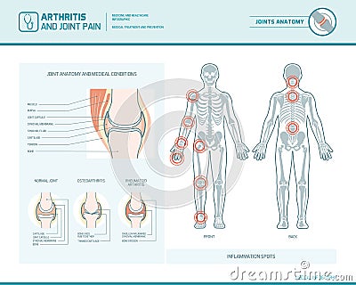 Arthritis and joint pain infographic Vector Illustration