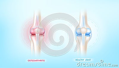 Arthritis knee joint in leg and bone healthy. Human bone anatomy damage treatment osteoarthritis. Skeleton x ray scan concept. Vector Illustration