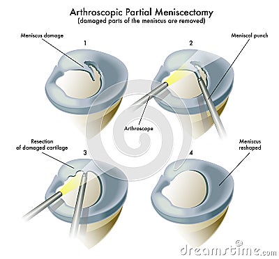 Arthroscopic Partial Meniscectomy Vector Illustration