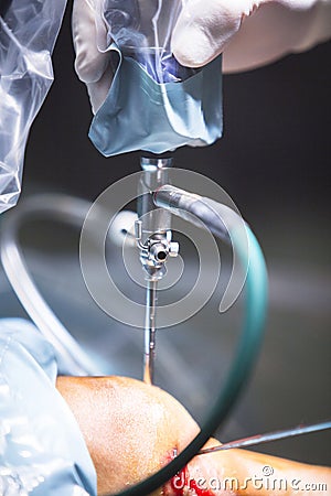 Arthroscopy orthopedic surgery knee arthroscope probe Stock Photo