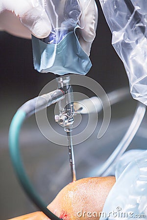 Arthroscopy orthopedic surgery knee arthroscope probe Stock Photo