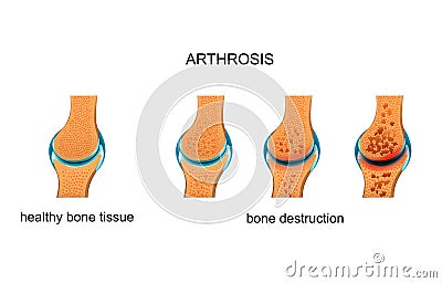 Arthrosis. bone destruction Vector Illustration
