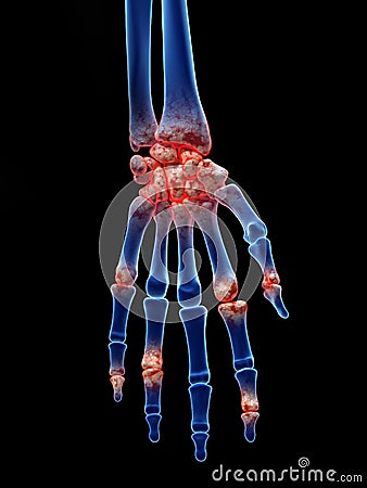 Arthrosis in the hand Cartoon Illustration