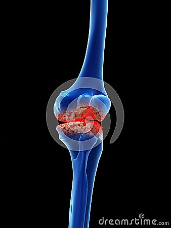 Arthrosis in the knee Cartoon Illustration