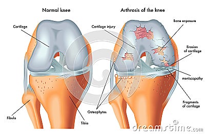 Arthrosis of the knee Vector Illustration