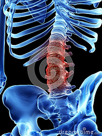 Arthrosis in the lumbar spine Cartoon Illustration