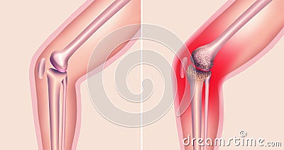 Arthrosis medical illustration diagram with damaged knee structure and healthy knee comparison. Cartoon Illustration