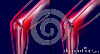 Arthrosis medical illustration diagram with damaged knee structure and healthy knee comparison. Cartoon Illustration