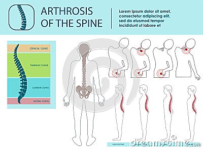 Arthrosis of Spine. Vector Illustration. Vector Illustration