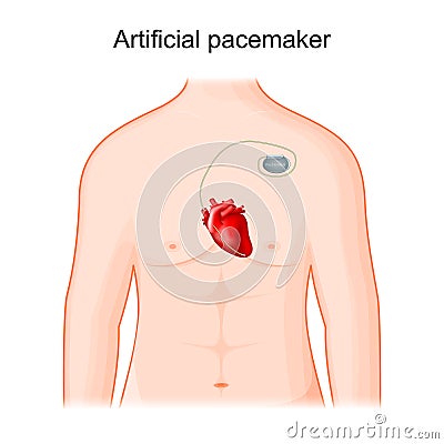 Artificial cardiac pacemaker. Human heart Vector Illustration