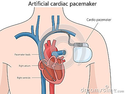 Artificial cardiac pacemaker medical device Cartoon Illustration