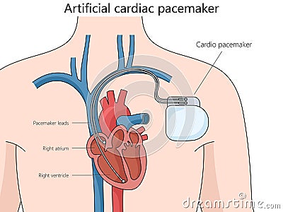 Artificial cardiac pacemaker medical device Vector Illustration