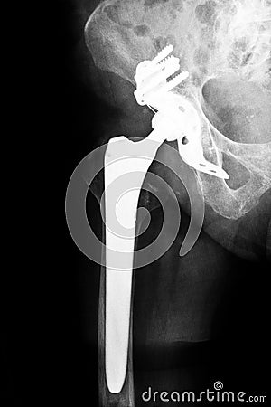 Artificial hip joint Stock Photo