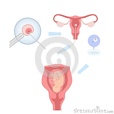 Artificial insemination illustration, process infographics. Vector illustration Cartoon Illustration