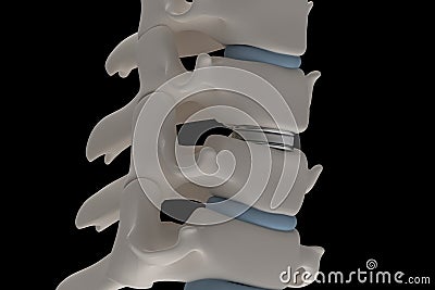 Artificial intervertebral disc prosthesis is installed between t Stock Photo