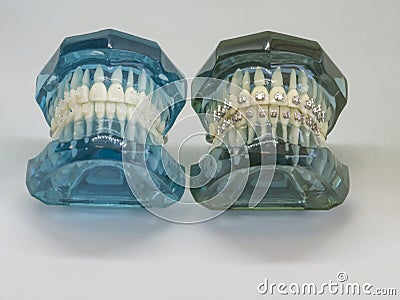 Artificial model of human jaw with wire colorful braces attached Stock Photo