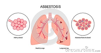 Asbestosis lung disease Vector Illustration