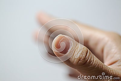 Thin layers of the fingernails peeling Stock Photo