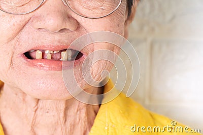 Asian Elderly woman over 70 years old be smile with a few broken teeth here have problem of ability to chew food of the elderly. H Stock Photo