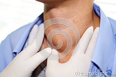 Asian lady woman patient have abnormal enlargement of thyroid gland Hyperthyroidism overactive thyroid at the throat. Stock Photo