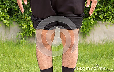 Asian man bandy-legged shape of the physiological bow leg Stock Photo