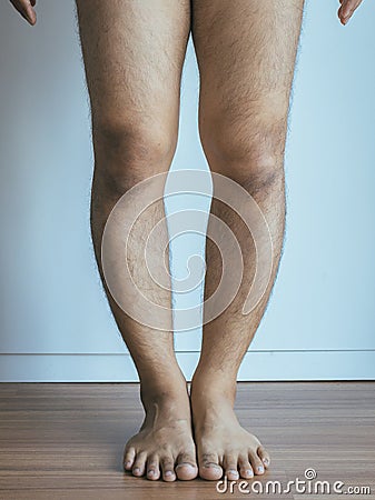 Asian man leg bandy-legged shape of the leg Stock Photo
