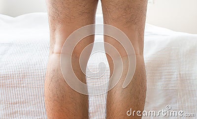Asian man leg bandy-legged shape of the legs Stock Photo