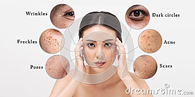 Asian woman with facial skin problems. Stock Photo