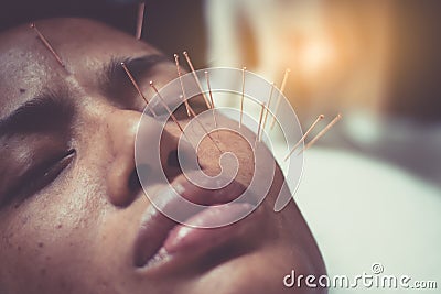 Asian women 40 years old acupuncture acupuncture on face Stock Photo