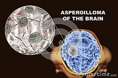 Aspergilloma of the brain and close-up view of fungi Aspergillus Cartoon Illustration