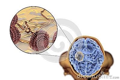 Aspergilloma of the brain and close-up view of fungi Aspergillus Cartoon Illustration