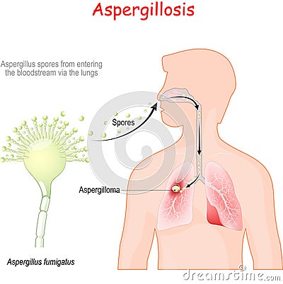 Aspergillosis. life cycle of pathogenic flora Vector Illustration