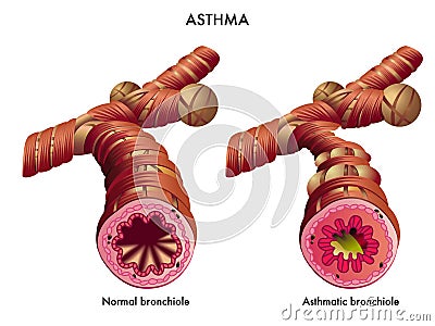 Asthma