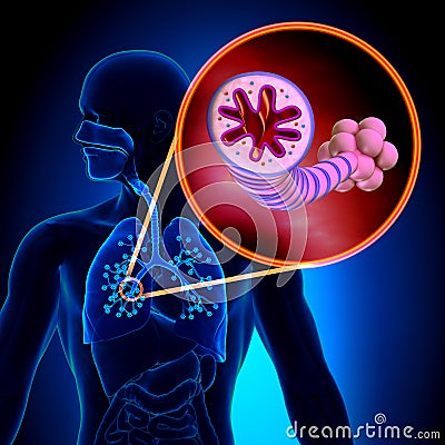 Asthma - Chronic Inflammatory Disease - anatomy Stock Photo