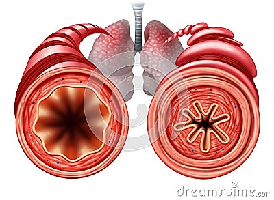 Asthma Diagram Medical Concept Cartoon Illustration